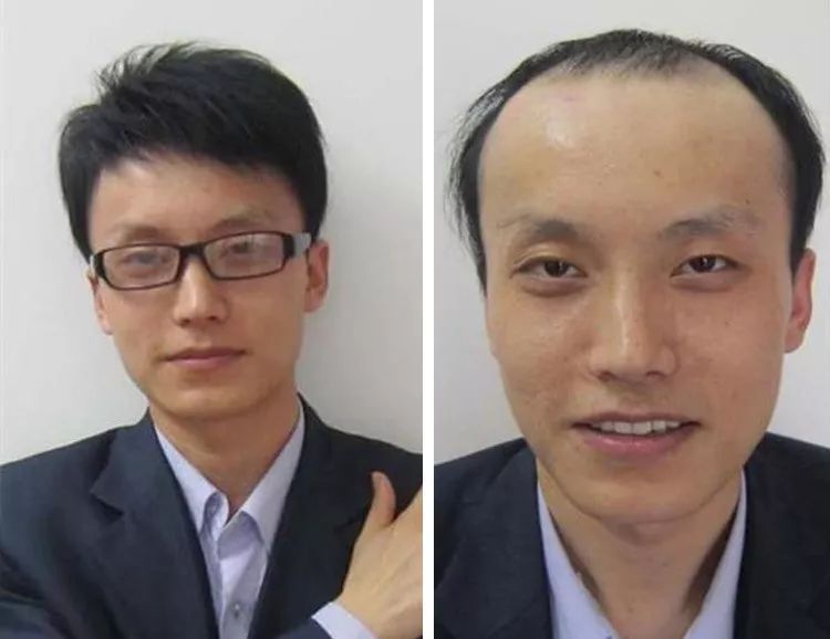 拯救你的发髻线,秃顶!40年老中医的【防脱秘方】可能重塑你的形象?