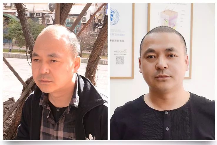 6小时长出真头发,脱发,地中海必看!