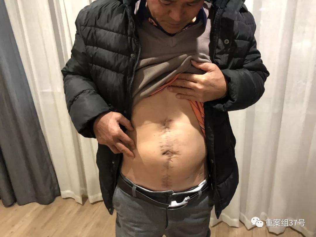 子弹击穿吴方强腹部，留下一尺长的手术疤痕。 新京报记者 卢通 摄