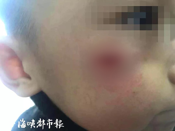 男童脸部被划出很深的一道口子