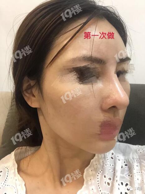 漂亮姑娘鼻整形失败 三次修复也无济于事 我的人生都灰暗了