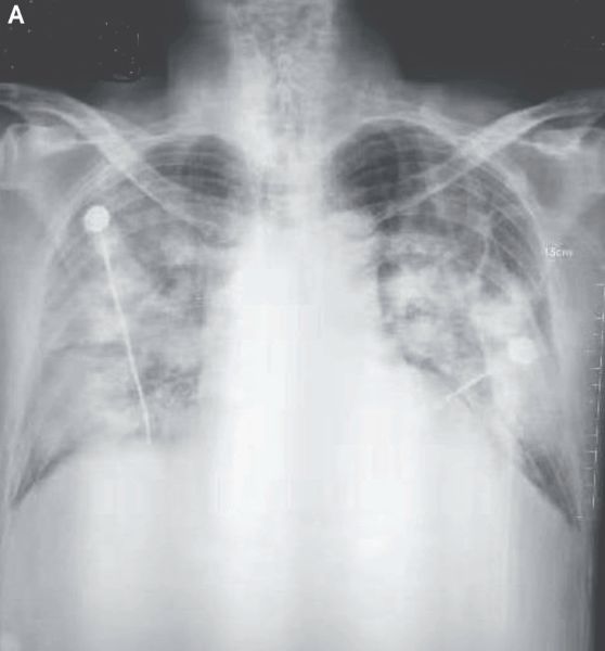 新型冠状病毒肺炎的胸部X光片
图片来源：NEJM