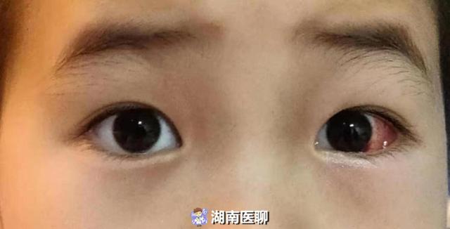 斜视会随年龄增长变好 不用治疗 莫让斗鸡眼 坑 了你