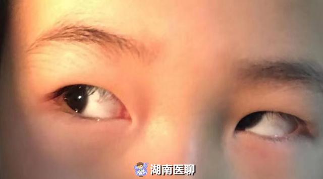 斜视会随年龄增长变好 不用治疗 莫让斗鸡眼 坑 了你