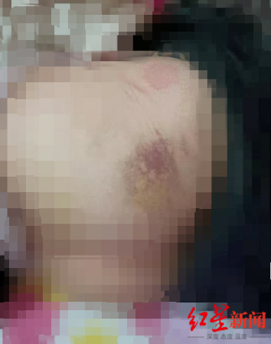 ▲小娟身上多处淤青