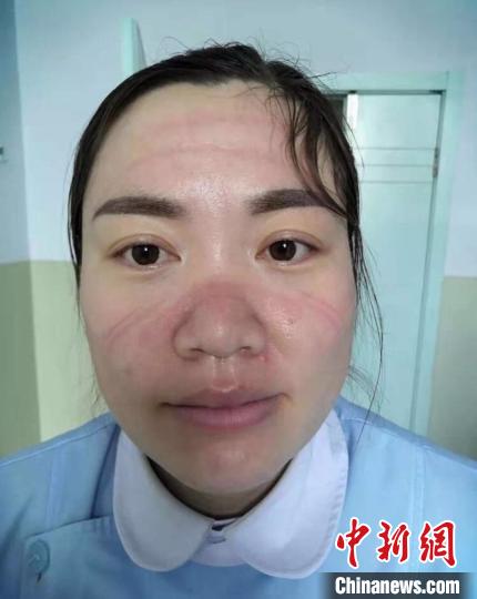 每次换下厚厚的防护服以及口罩、护目镜,出现在眼前的是一张张长时间被汗水浸泡变得肿胀、苍白的脸,一道道深深的勒痕折射出救护、治疗的艰辛和困苦,但他们没有半句怨言。 阳城县委宣传部供图