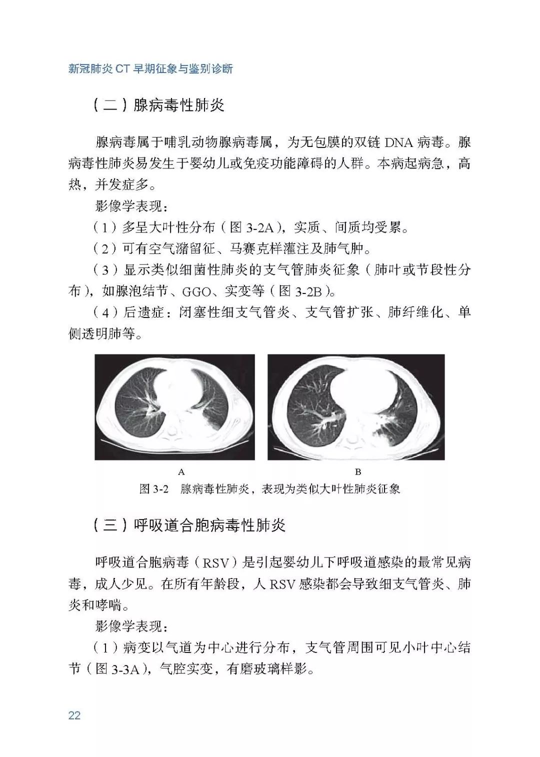 《新冠肺炎ct早期征象与鉴别诊断
