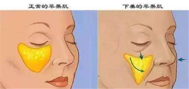 苹果肌下垂: 宋慧乔苹果肌下垂,少女感尽失?原来脸上这两坨这么重要啊 宋慧乔苹果肌下垂,少女感尽失?原来脸上这两坨这么重要啊