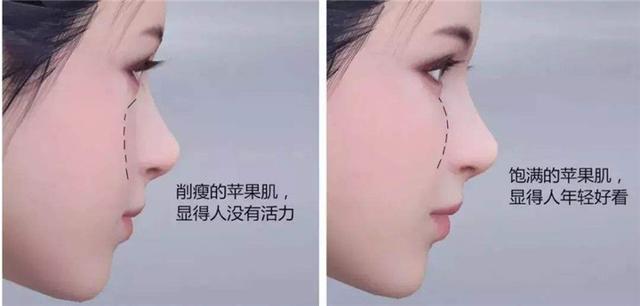 苹果肌下垂: 宋慧乔苹果肌下垂,少女感尽失?原来脸上这两坨这么重要啊 宋慧乔苹果肌下垂,少女感尽失?原来脸上这两坨这么重要啊