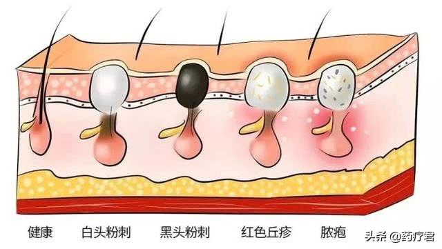 草莓鼻有恢复的可能吗 毛孔粗大有黑头怎么办?教你一招,轻松干掉“草莓鼻”