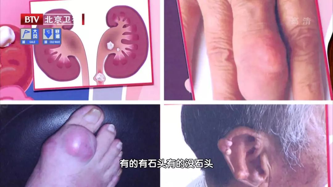 反复痛风,痛在骨头,伤在肾脏!名老中医带来三杯水,尿酸轻松降下来~