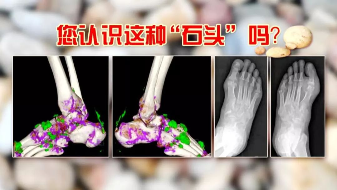 反复痛风,痛在骨头,伤在肾脏!名老中医带来三杯水,尿酸轻松降下来~