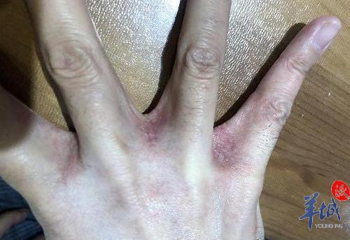 过度洗手洗出湿疹?专家建议洗完手后应及时涂抹润手霜保护皮肤屏障