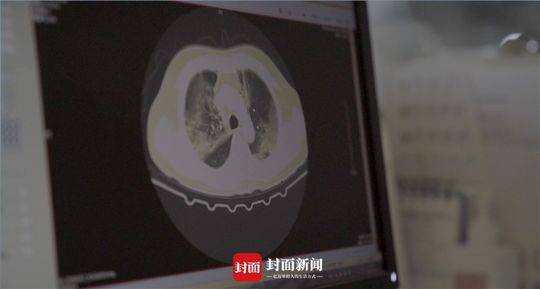 一位患者的肺部ct表现受到严峻熏染