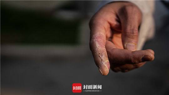 被消毒液侵蚀的医务职员的手