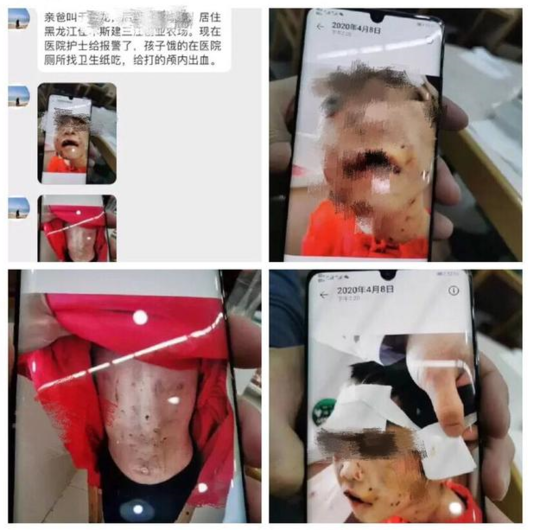 女童被生父继母虐打住院后续:仍在昏迷 3天筹