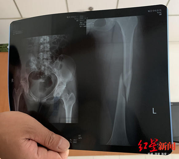 女子练瑜伽致股骨骨折：教练当时把身体都压上去了