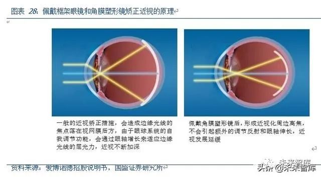 什么是特殊角膜接触镜,什么是特殊角膜接触镜的作用