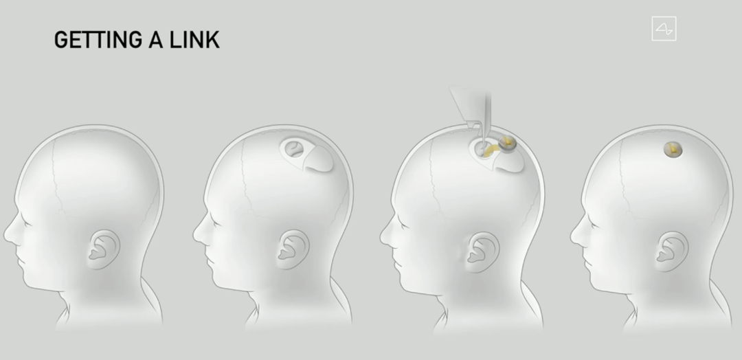 图片来源：Neuralink 发布会