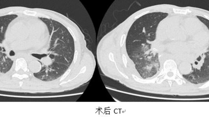 8年前罕见患乳腺癌63岁上海爷叔胸腔又长占据75的巨大肿瘤