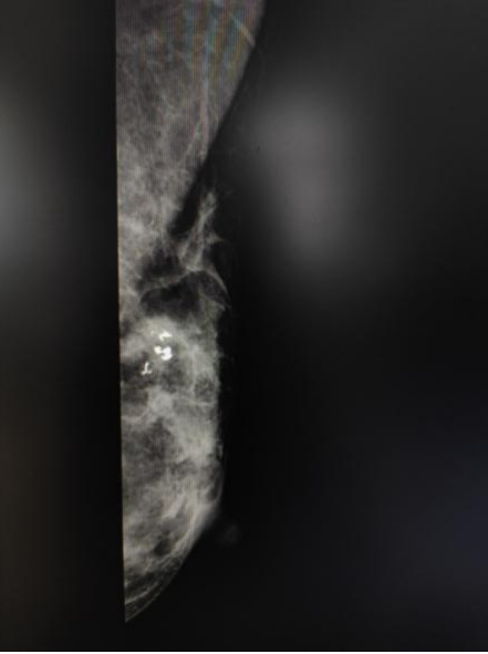 揭开粉红杀手乳腺癌的神秘面纱一文读懂乳腺癌