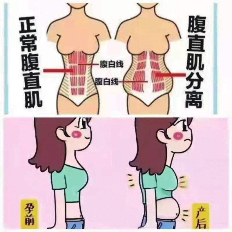 "腹直肌分离"知多少