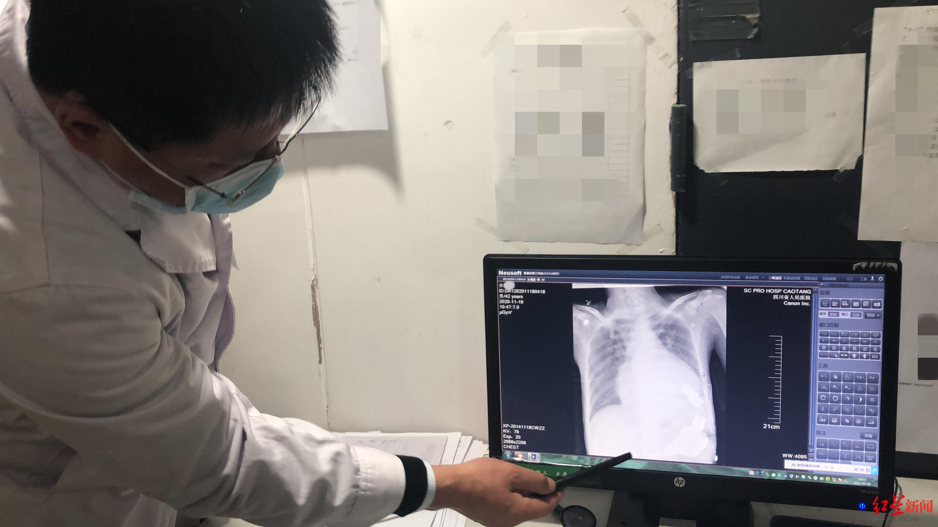 全国首例商品化人工心脏植入手术患者出院