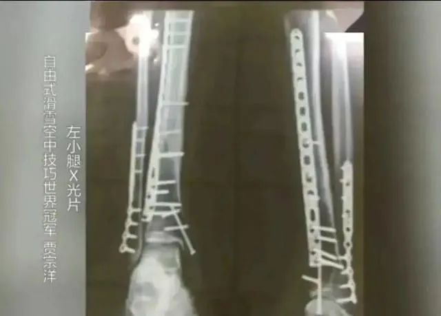 和奥运金牌擦肩而过四次,他的小腿里留下22根钢钉 和奥运金牌擦肩而过四次,他的小腿里留下22根钢钉