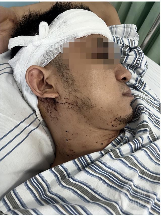 小谭头部有4处缝针,脑震荡伴视力模糊伤情:头部有4处缝针,脑震荡伴视