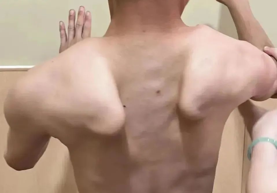 怎么样肌肉才不萎缩 11ac-02ddfa8b291a69cb8cc0f3672d5e5b0c.jpg