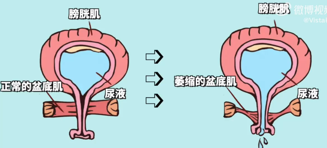 几个月会感觉尿颤 7d9e-edbd543435ba01c4e9473d75b8093182.png