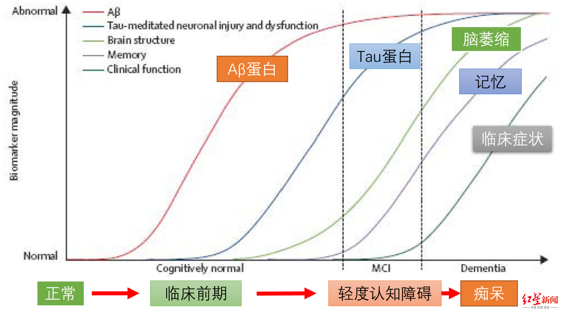 ↑阿尔茨海默症的病情发展阶段