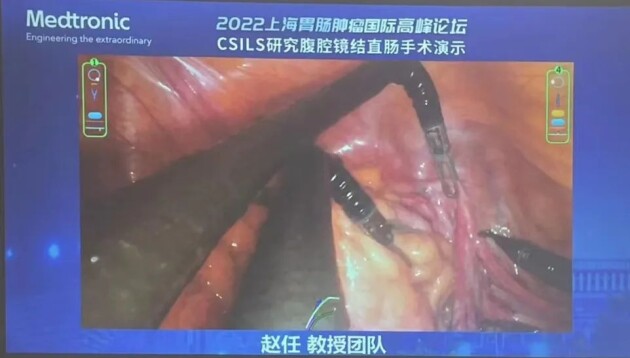 ▲赵任院长直肠癌根治手术直播中