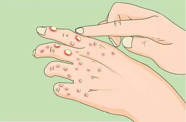 儿童手上起水泡怎么回事 39de-b792fdad066fe5355eecfe573e3ed05d.png