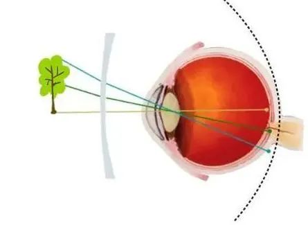 功能性镜片有什么,功能性镜片有什么好处
