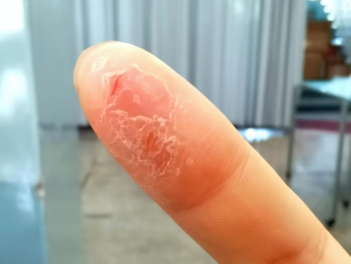 圖說：記者在瑞幸咖啡工作期間，右手食指「爛手」最嚴重時。圖源：記者