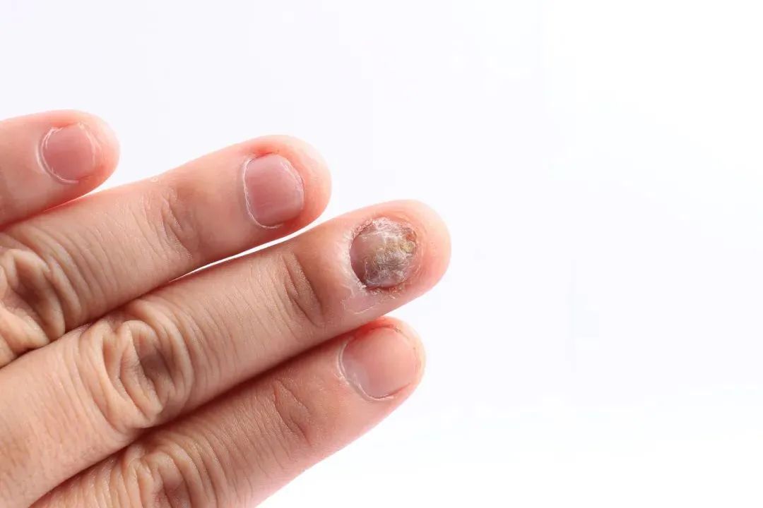 灰指甲怎么传染的 faba-487a62403c2fbb1e9d600a20a5ab18bf.jpg