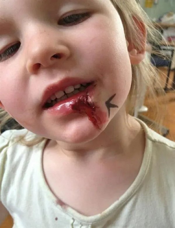 6号染色体缺失 英国女孩无痛觉、无饥饿、无疲劳:全球唯一