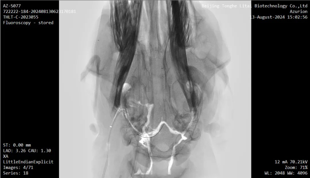 全球首例,介入式脑机接口传感器血管内取出试验在北京完成