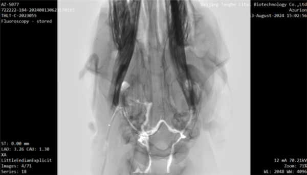 全球首例!我国介入式脑机接口传感器血管内取出试验成功