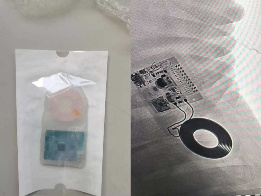 全球首例,介入式脑机接口传感器血管内取出试验在北京完成