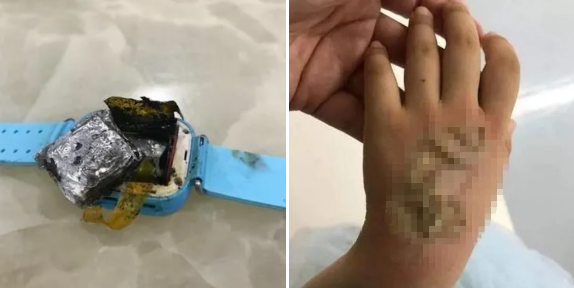 手背烫伤留疤图片 59fb-490800dd9fad5c0de62e1fcbd52db125.png