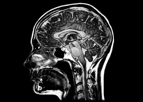 5万次扫描揭示大脑衰老五大模式
