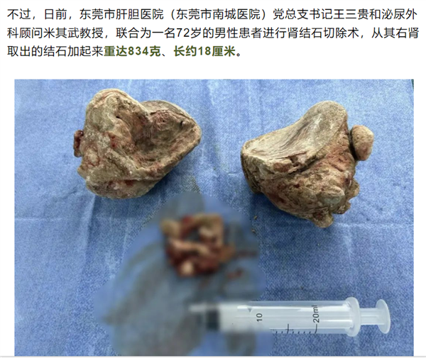 肾结石怎么引起的男性 e11d-3e0e218b50eaed3e36feefa8991ba721.png