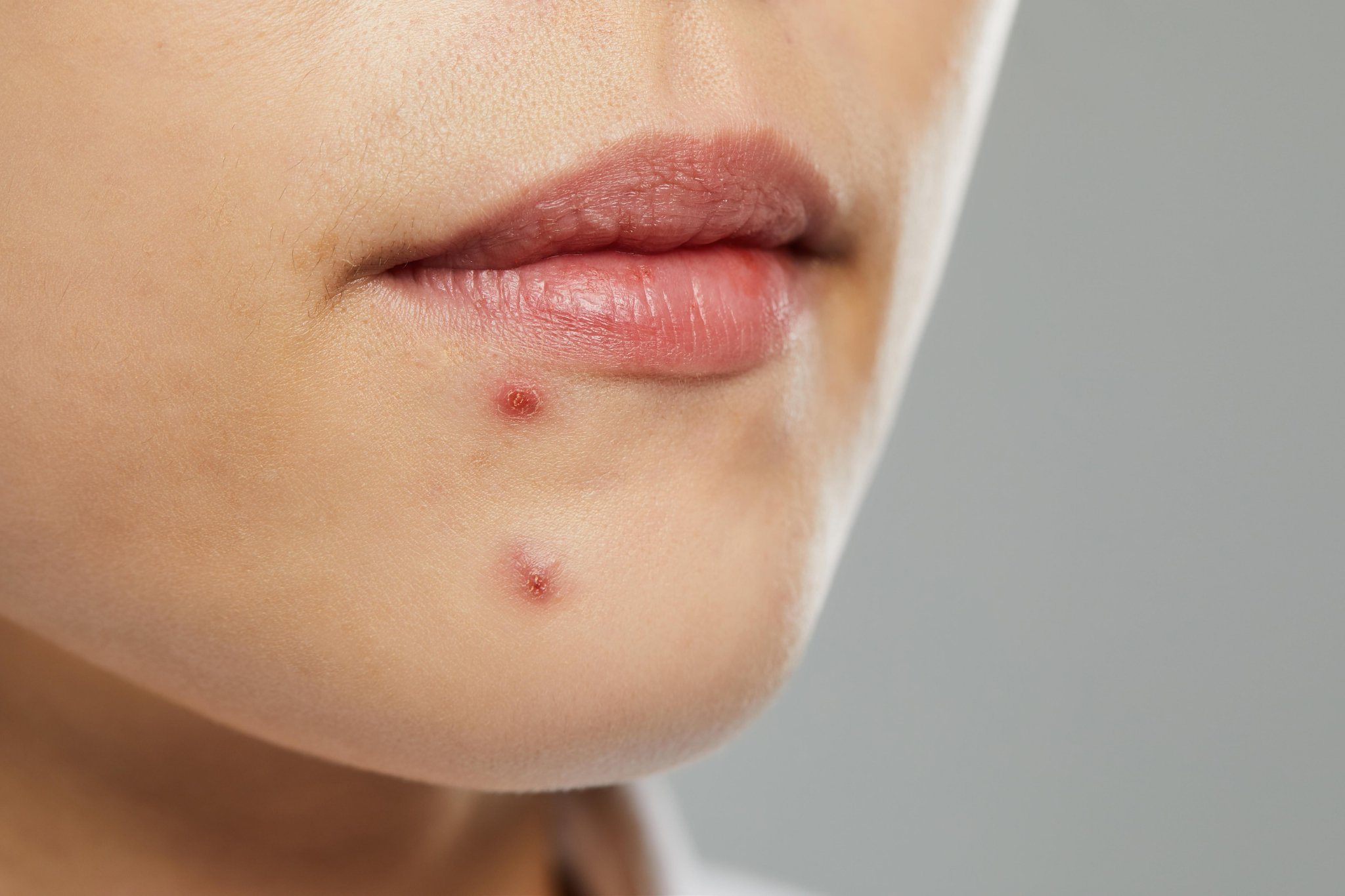 下巴长痘痘是什么原因？