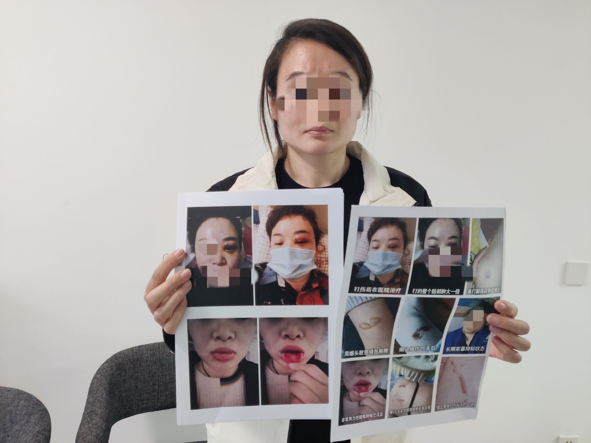 女方展示自己的傷痕