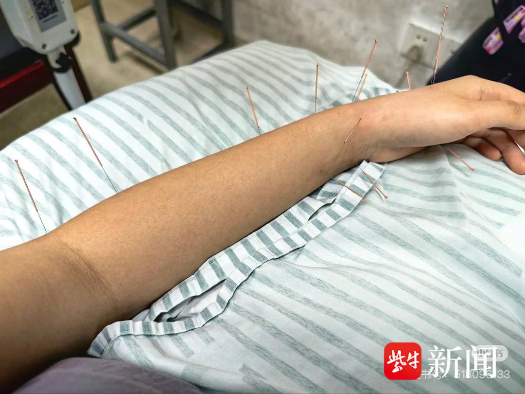 陳女士進行針灸治療