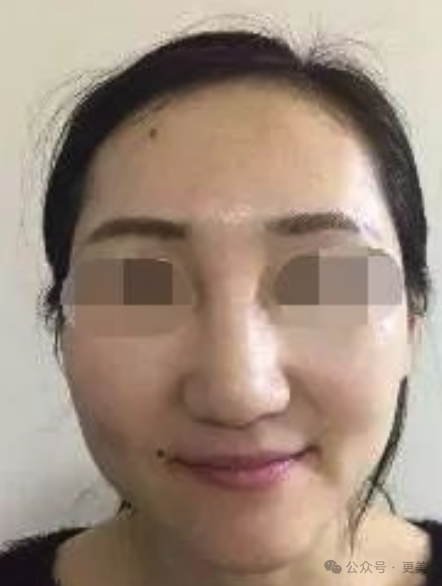 △传统注射隆鼻变宽的根源