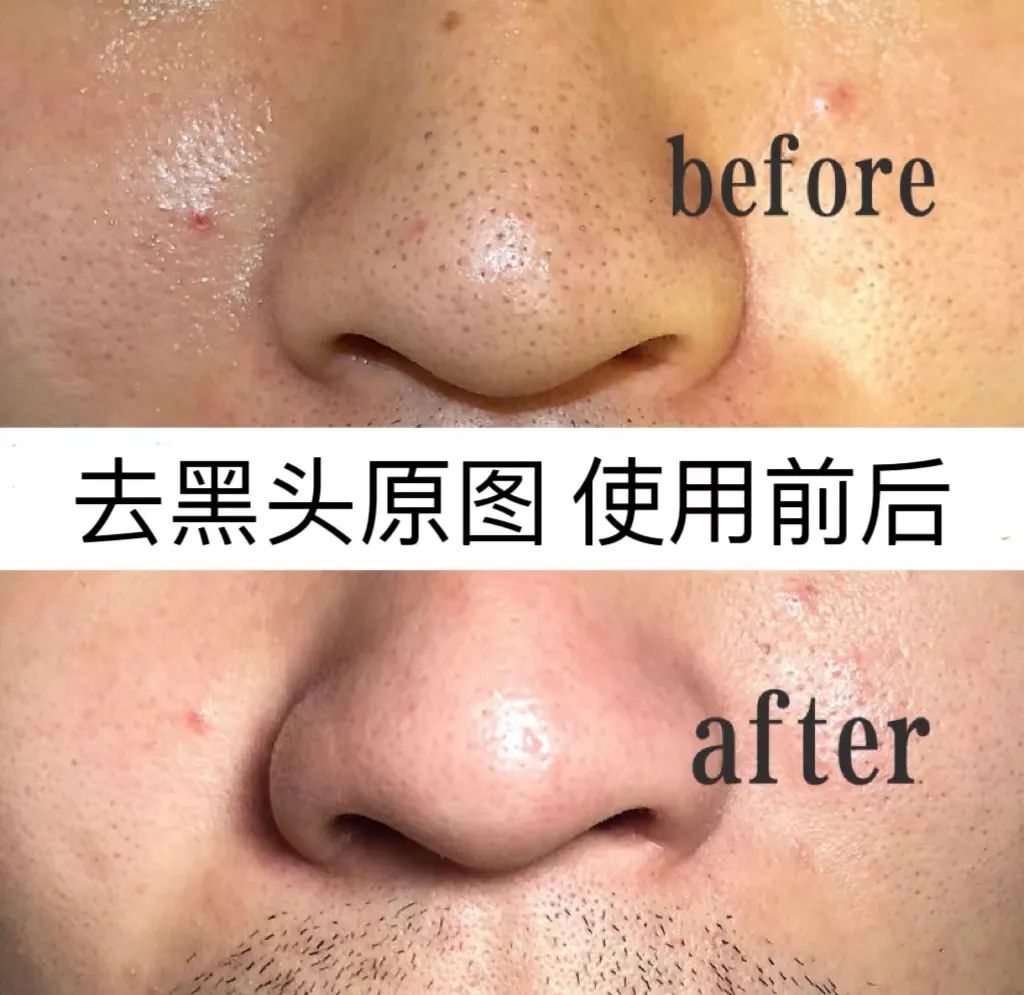 啥是黑头 b3e4-e8837ab44f63e50295dd7e2915e4a93b.jpg