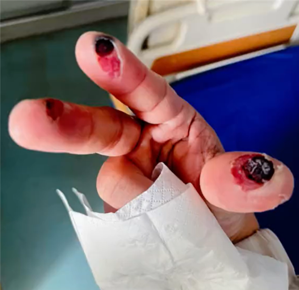 水烧伤吃什么好 afa9-402c75fc24ffaaf448a9f86a26531b9e.png